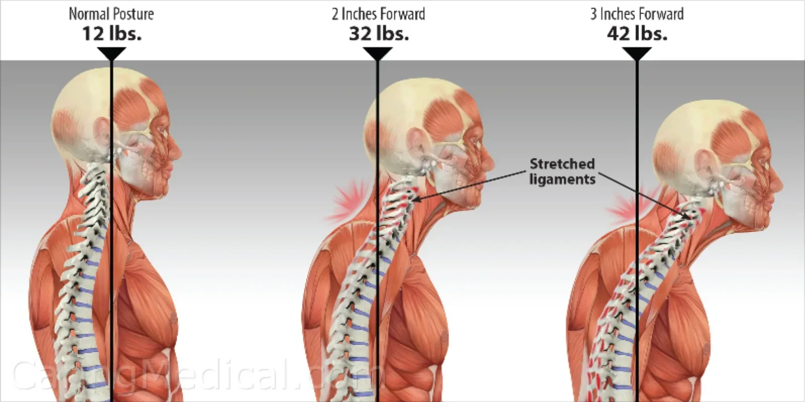 Cervical Spondylosis (Neck Wear & Tear) Treatment