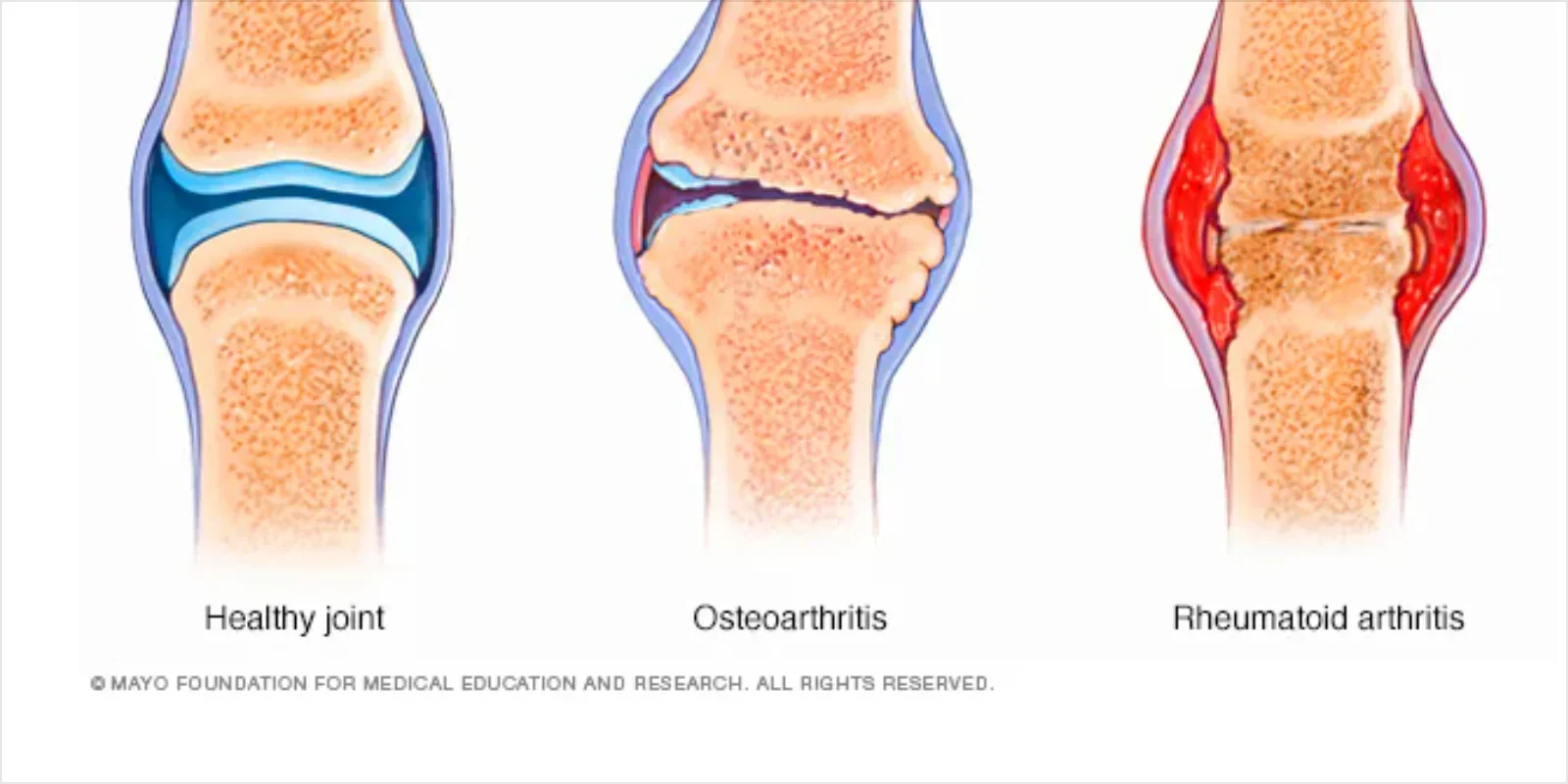 Arthritis Pain Relief