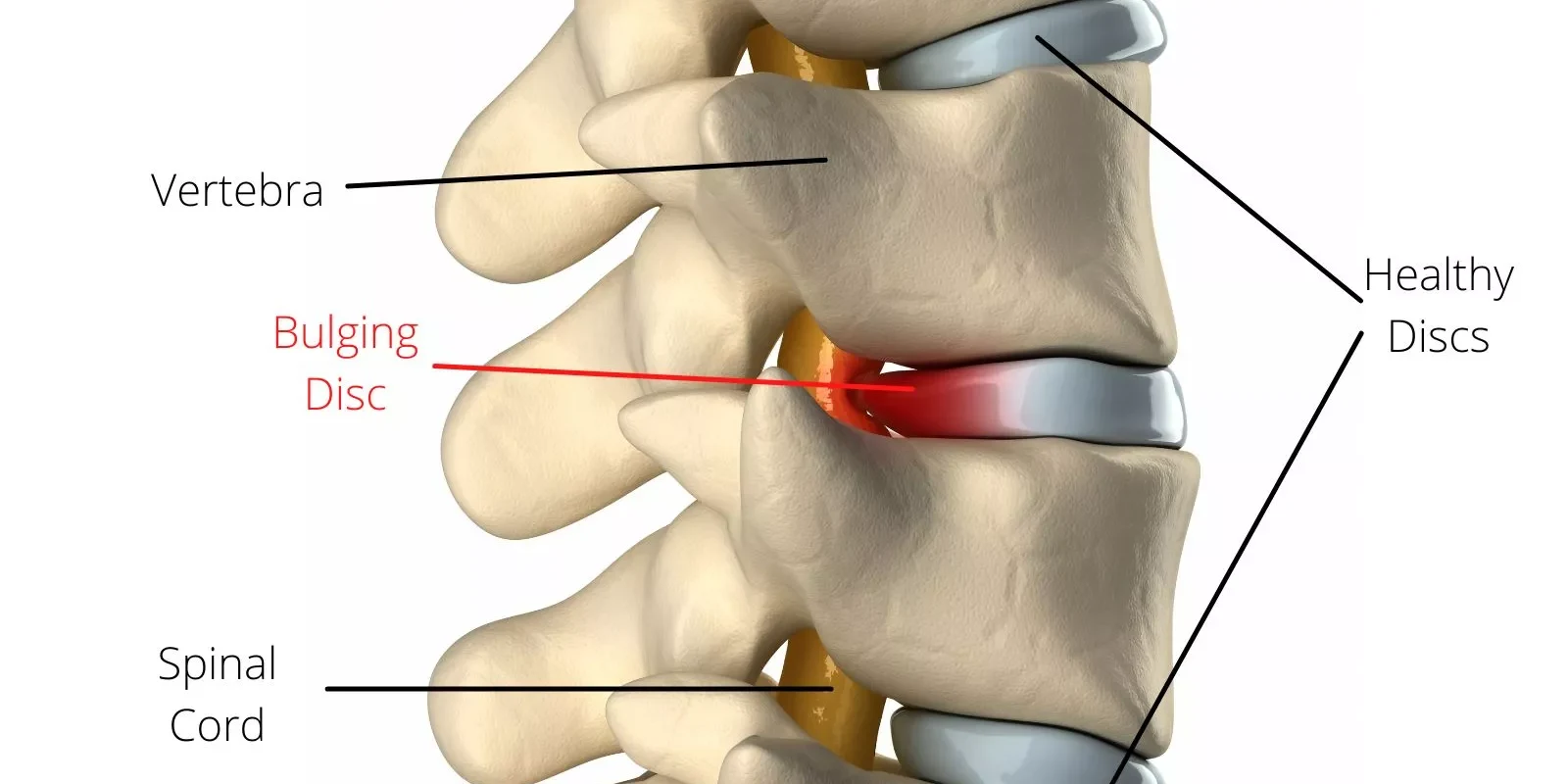 Disc Bulge Slip disc