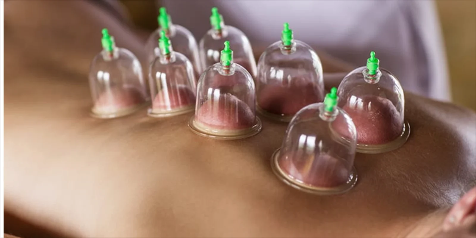 Dry Cupping Therapy