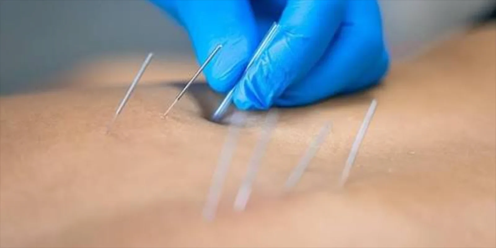 Dry Needling Therapy