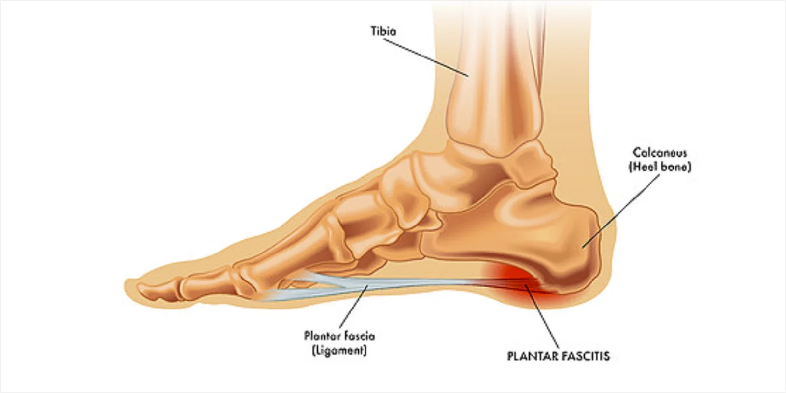 Plantar Fasciitis (Heel Pain) Treatment
