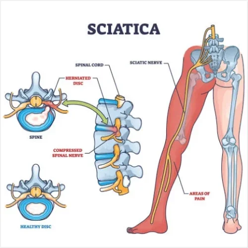 Sciatica Treatment (Pain Running Down the Leg)