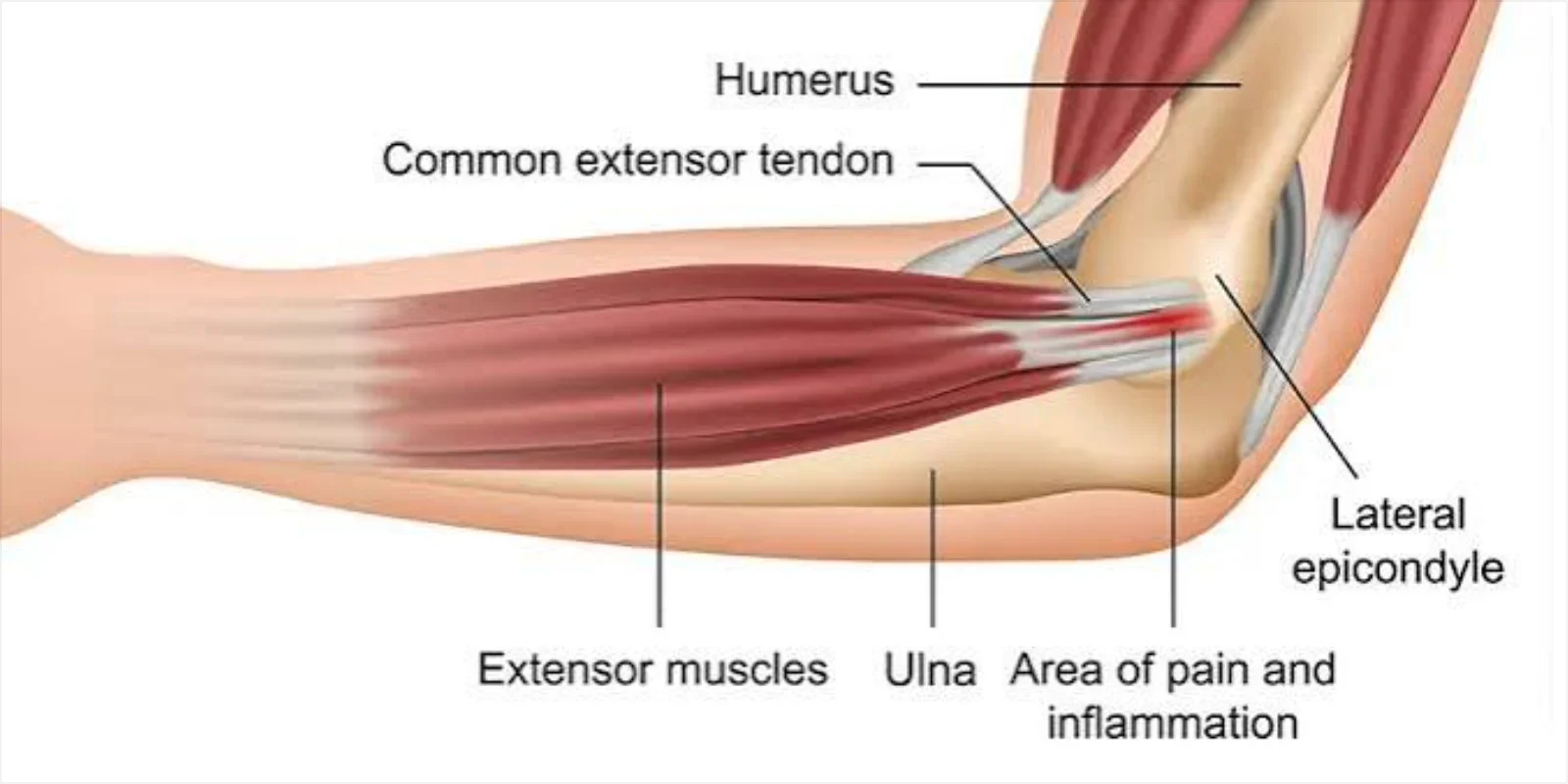 Tennis Elbow Treatment